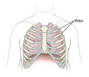 difference between bruised and cracked ribs